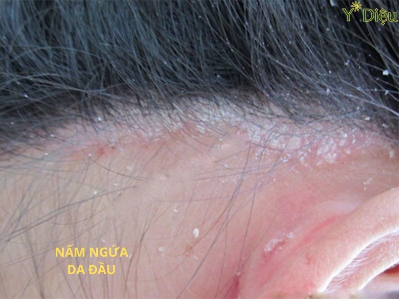 Da đầu bị nấm làm tóc dễ gãy dụng và gây ngứa